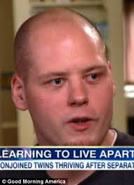 Family's joy as conjoined twins are thriving a year after they were  separated in complicated surgery