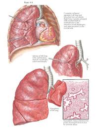 Pulmonary Agenesis Aplasia A Nd Hypoplasia Three Different Degrees Of Arrested Development Of The Lungs May Occ Pulmonary Neuromuscular Respiratory System