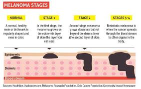 That's why skin exams, both at home and with a dermatologist, are especially vital. National Council On Skin Cancer Prevention Protection And Early Detection Is The Key To Melanoma Survival Facebook