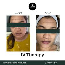 Stretch Marks Treatment Near Me in Pune Starting @ Cost ₹3000/-