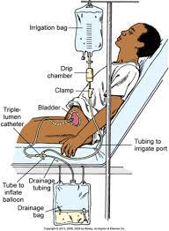 Continuous Bladder Irrigation Cbi Flashcards Quizlet