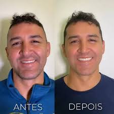✨ A transformação fala por si só! ✨ Um novo sorriso é capaz de mudar não só  a estética, mas também a autoconfiança e a qualidade de vida. Agende sua  avaliação gratuita