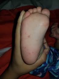 However, plantar warts can develop on the soles of your feet, which can become. Red Spot On Toddlers Feet Babycenter