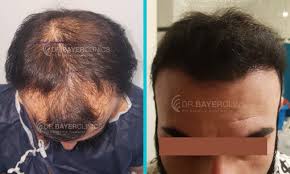 قبل وبعد زراعة الشعر Beauty