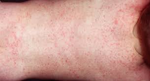 With its long duration and physical symptoms, roseola is just the kind of thing that can make a. Roseola Babycentre Uk