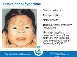 Alcohol use in Pregnancy ? Under the Radar