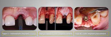 Update On Timing Of Implant Placement After Tooth Extraction Oral Health Group