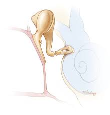 Image result for Ossicular Chain Disruption