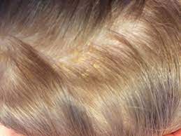 Occasionally, there is hair loss in the affected area, so please be reassured that this is normal. Wonder Review Uriage Cradle Cap Cream And Shampoo Wonderbaba
