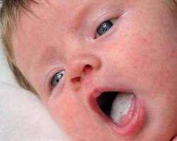 Hình ảnh về Trẻ sơ sinh bị tưa miệng