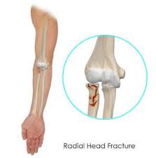 Image result for Radial Head Dislocation