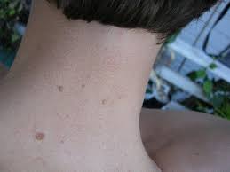 Skin cancer diagnosis always requires a skin biopsy. How To Check For Skin Cancer In 10 Minutes Organic Authority