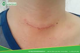 Song, đây là loại ung thư có khả. BÆ°á»›u Cá»• Co Thá»±c Sá»± Nguy Hiá»ƒm Khong Bá»‡nh Viá»‡n Binh Dan Ä'a Náºµng