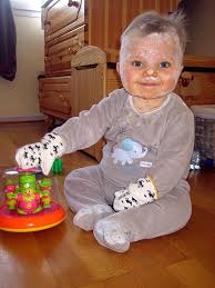 Image result for scabies human children
