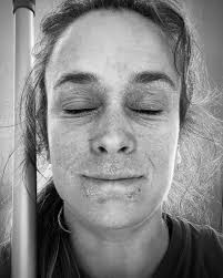 Mijn verhaal over eczeem, hormoonzalf, afkicken en herstel.  https://melissamendelmassages.nl/2025/05/25/danseres-met-een-verslaving/