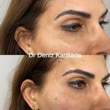 This wrinkle is only temporary after this, the threads will most likely begin to dissolve, and the look will begin to slowly fade. Eye Brow Lift And Cat Eye Fox Eye Lift Dr Deniz Kanliada