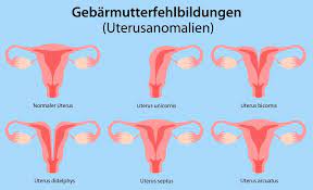Fehlbildung Der Gebarmutter Ursachen Formen Behandlung