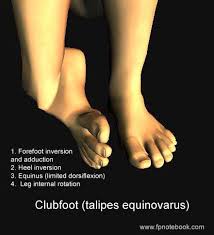 Image result for Clubfoot