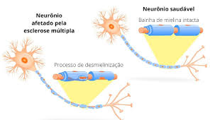 Application with information about multiple sclerosis, for patients and other interested parties. Esclerose Multipla Causas Sintomas Classificacoes Biologia Net