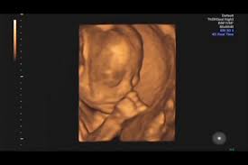 You'll notice that what you see varies a lot by the number of weeks of gestation. 4d Ultrasound Study Of Fetal Facial Expressions At 20 24 Weeks Of Gestation Sciencedirect