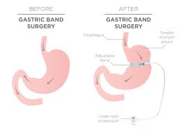 Gastric band price vs gastric mind band price. Weight Loss Surgery Costs In The Uk Abroad Qunomedical