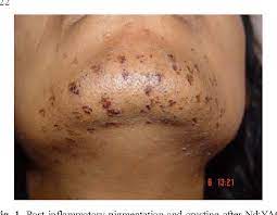 Laser hair removal is inherently safe. A Review Of The Adverse Effects Of Laser Hair Removal Semantic Scholar