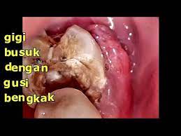 Gusi bengkak juga dikenali sebagai gingivitis. Gusi Bengkak Karena Gigi Berlubang Gigi Busuk Info Kesehatan Jogja Youtube