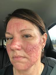 Lupus Awareness and Support