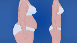 Endoscopic sleeve gastroplasty pricing includes: Low Cost Bariatric Surgery Affordable Weight Loss Solutions In Tijuana