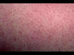 They are also appearing beside my eye now. How To Get Rid Of Chicken Skin On Arms Thighs And Butt Kerotosis Pilarsis Dml Style Youtube