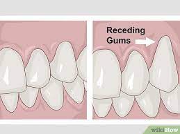 How To Stimulate Gum Growth Gum Treatment Gum Recession Treatment Gum Disease Treatment