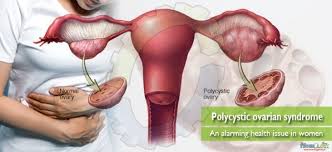 Read on to know how. Ovarian Cysts Naturally And Safely With Herbs And Supplement