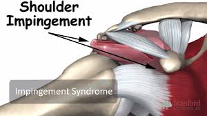 This inflammation to the tendons in shoulder impingement syndrome is a condition where rotator cuff tendons of the shoulders are. Shoulder Exam Stanford Medicine 25 Stanford Medicine