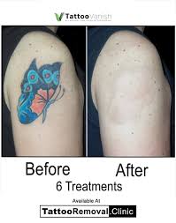 Modern tattoo removal lasers are effective at removing most tattoos, but not all tattoos can be we have great success rates of complete removal on a variety of skin tones, ages, and tattoo locations. Toronto S Premier Non Laser Tattoo Removal Clinic