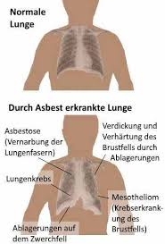 Duisburg asbeststaub hat am samstag in duisburg für einen großeinsatz von polizei und feuerwehr gesorgt. Asbest Gefahr Erkennen Heimtest Schnelltests De