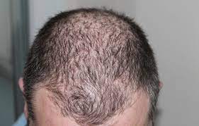The problem of ignoring is that when we face the situations we had been warned about, we complain and wonder how comes we did not see it coming. Hair Loss Dream Meaning And Symbolism