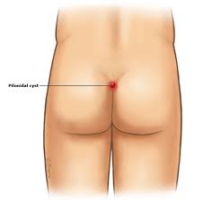 PILONIDAL DISEASE — General Surgery Langley