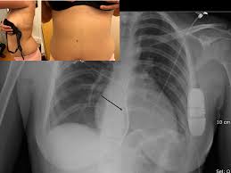 Anesthesia provider places magnet at case start and removes at. Technological Advances In Cardiac Pacing And Defibrillation