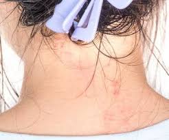Typical Symptoms Associated With Carmine Allergies Itchy Red Eyes Skin Dermatitis Red Dye Free Foods