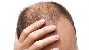 Proscar ® ( finasteride) is a prescription medication licensed to treat an enlarged prostate (also known medically as benign prostatic hyperplasia, benign prostatic hypertrophy, or bph ). Hair Loss And Prostate Drugs Linked To Persistent Erectile Dysfunction In Men Northwestern Now