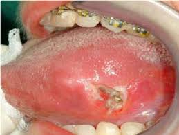 Image result for spinocellular carcinoma of the oral cavity
