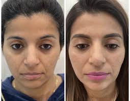 Rejuvenation Before and After