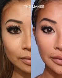 We did not find results for: Before And After Full Face Injecting Best Clinic Sydney For Dermal Fillers