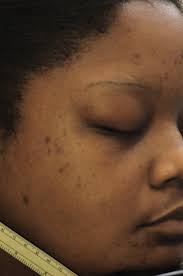 Reliability assessment and validation of the postacne hyperpigmentation  index (PAHPI), a new instrument to measure postinflammat