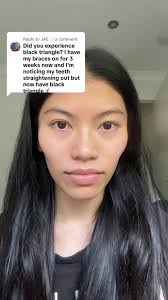 Get Tips for Adult Braces Journey