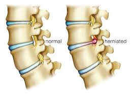 Include worsening muscle weakness, or numbness. Quora Page 7 Zpn