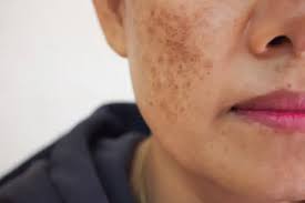 Image result for Melasma