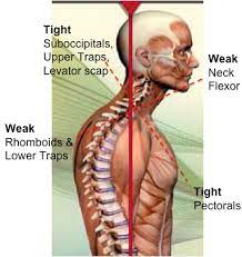 Using Integrative Massage To Treat Upper Cross Syndrome