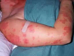 Chronic cutaneous lupus erythematosus, or discoid lupus. Cutaneous Lupus Erythematosus Dermnet Nz