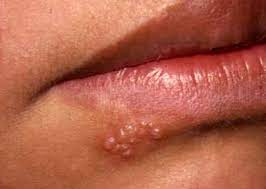 Herpes is a condition caused by the herpes simplex virus. Hsv Type 1 Microbiology Medbullets Step 1